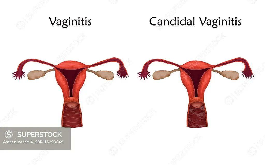 Vaginitis and candidal vaginitis, illustration