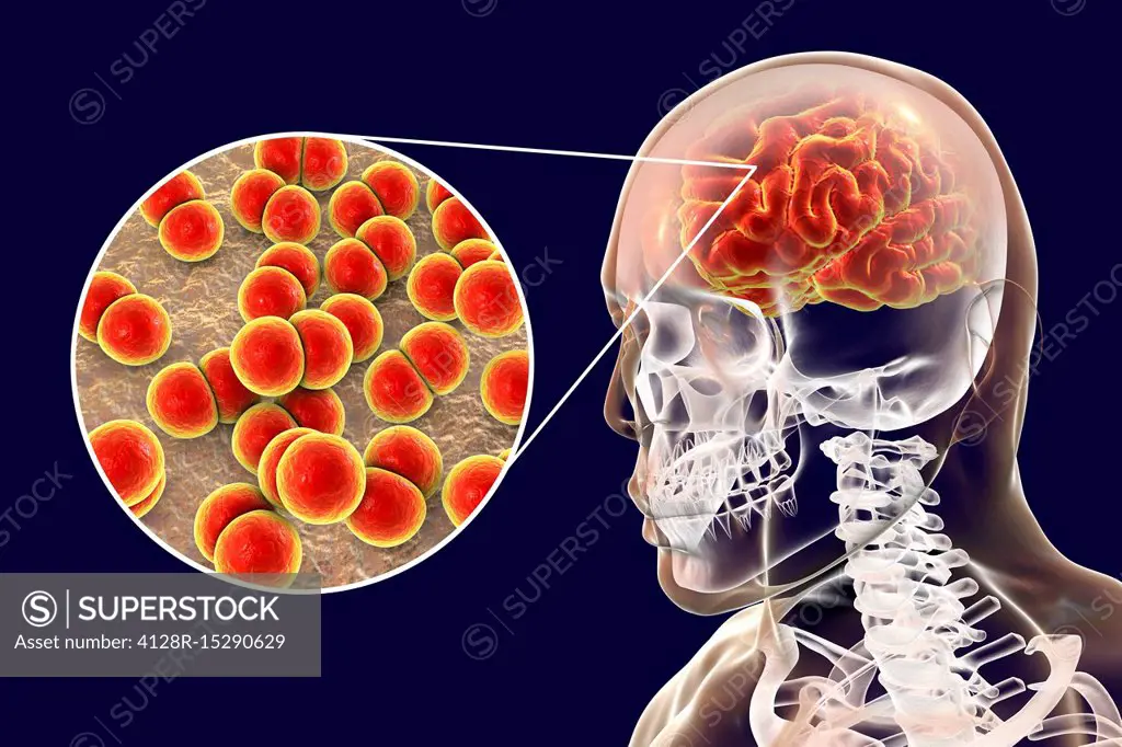 Neisseria meningitidis brain infection, illustration