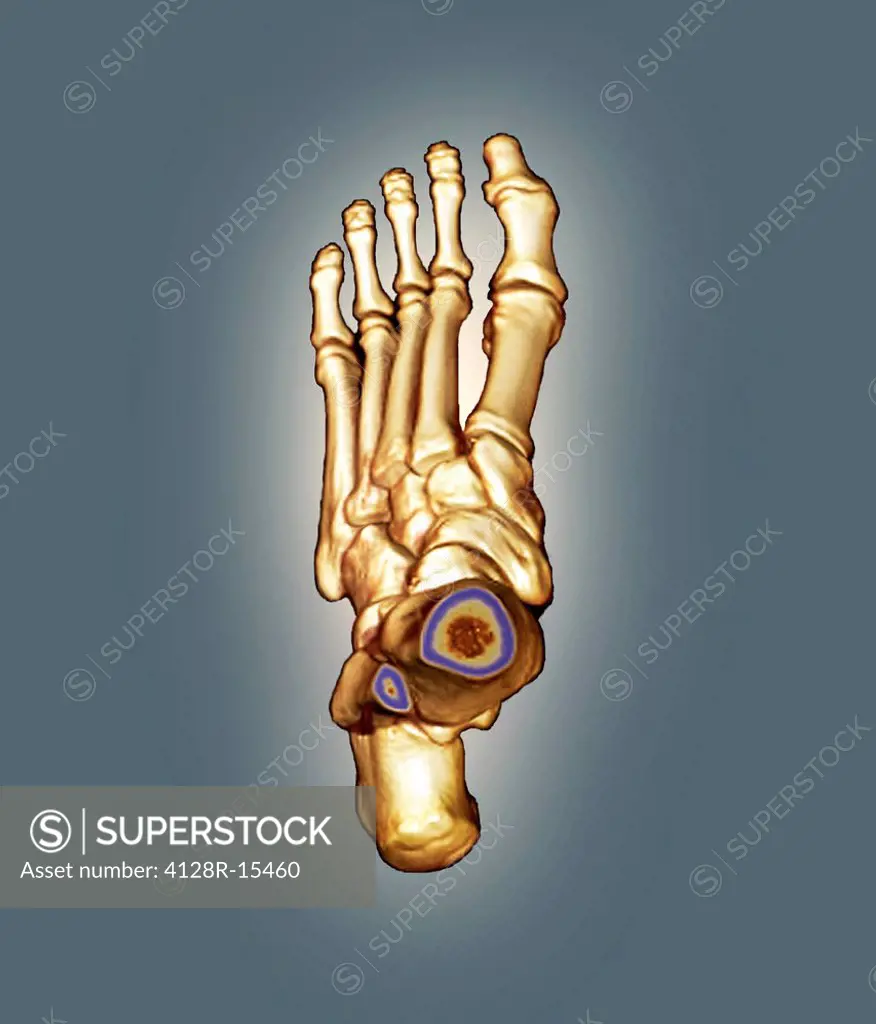 Normal foot. Coloured 3D computed tomography CT scan of the healthy foot of a 23 year old patient.