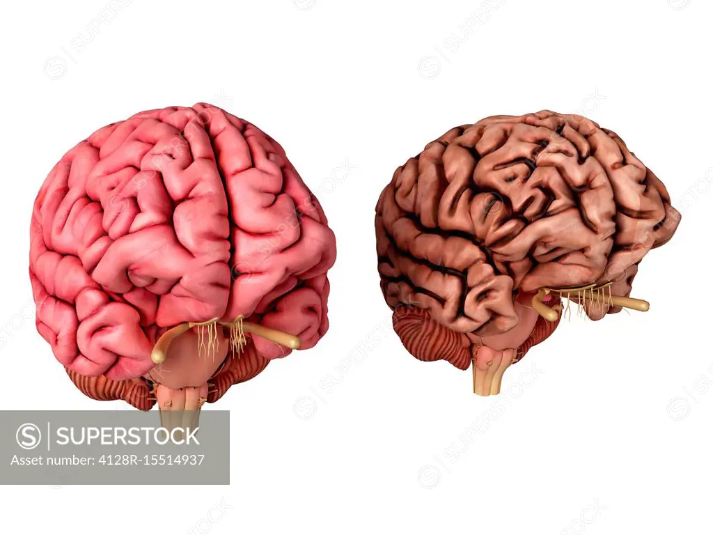 Illustration of a healthy and unhealthy brain