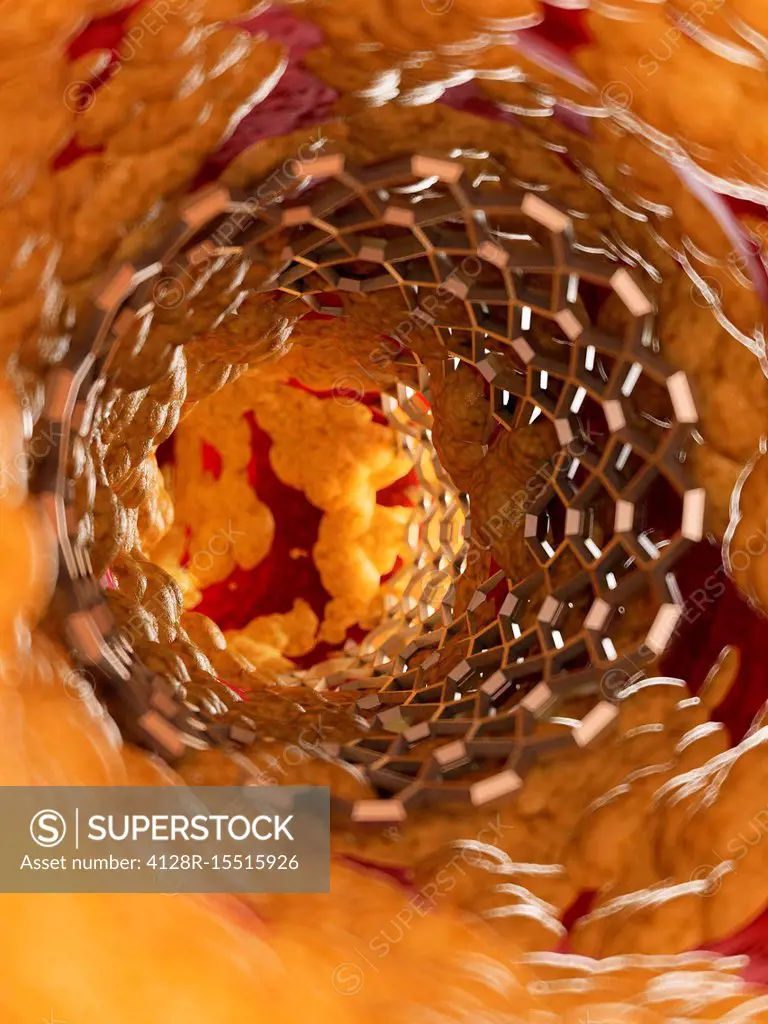 Illustration of a stent inside of a fatty artery