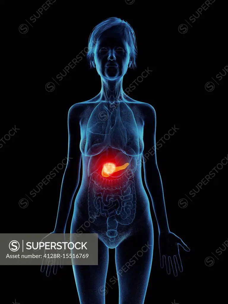 Illustration of an old woman's pancreas tumour