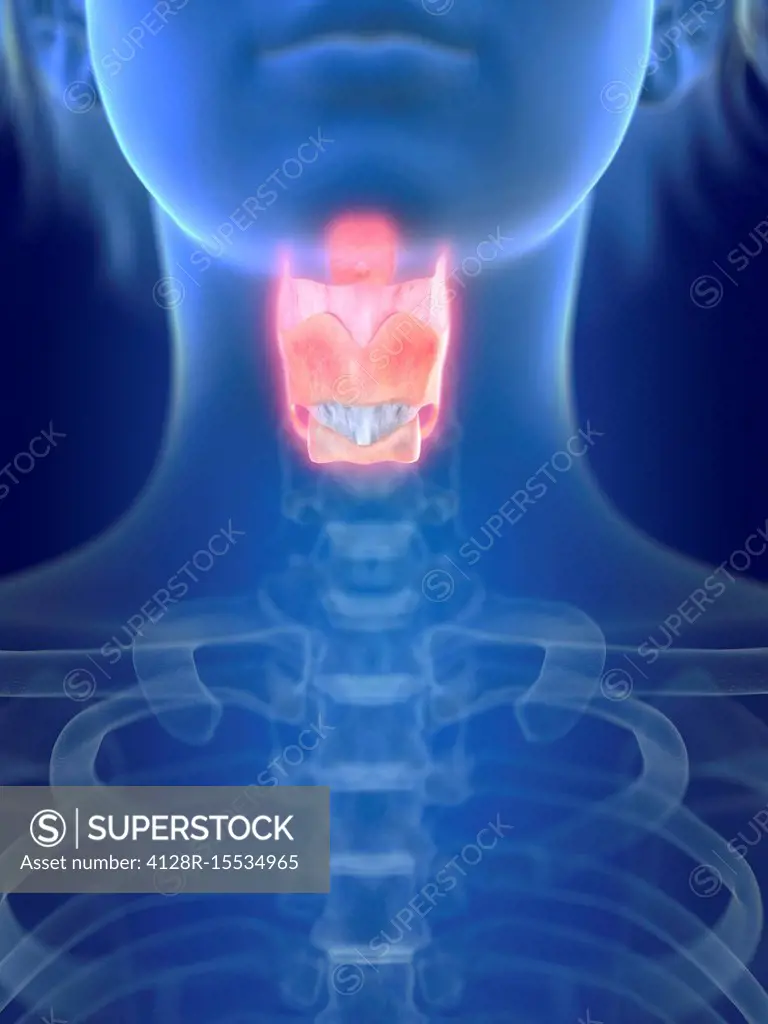 Illustration of an inflamed larynx