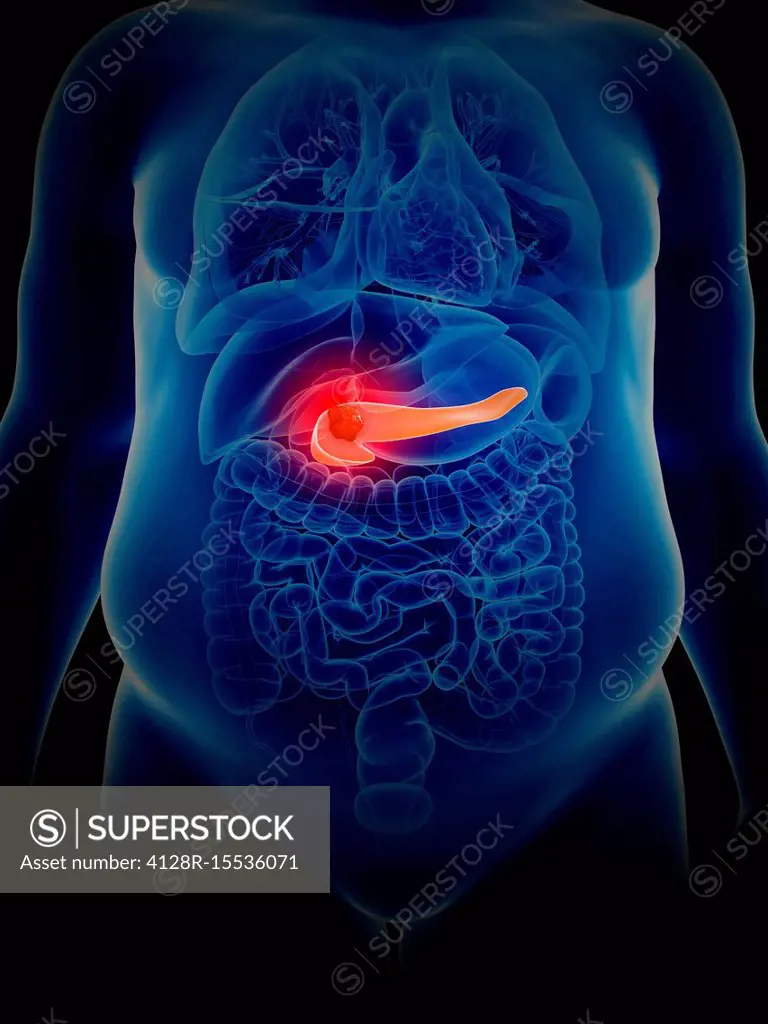 Illustration of pancreas cancer