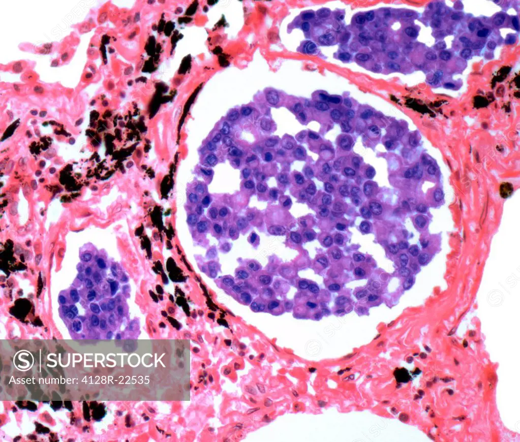 Secondary lung cancer. Light micrograph of a section through a secondary carcinoma of the lung. This cancer has metastasised spread from a primary tum...