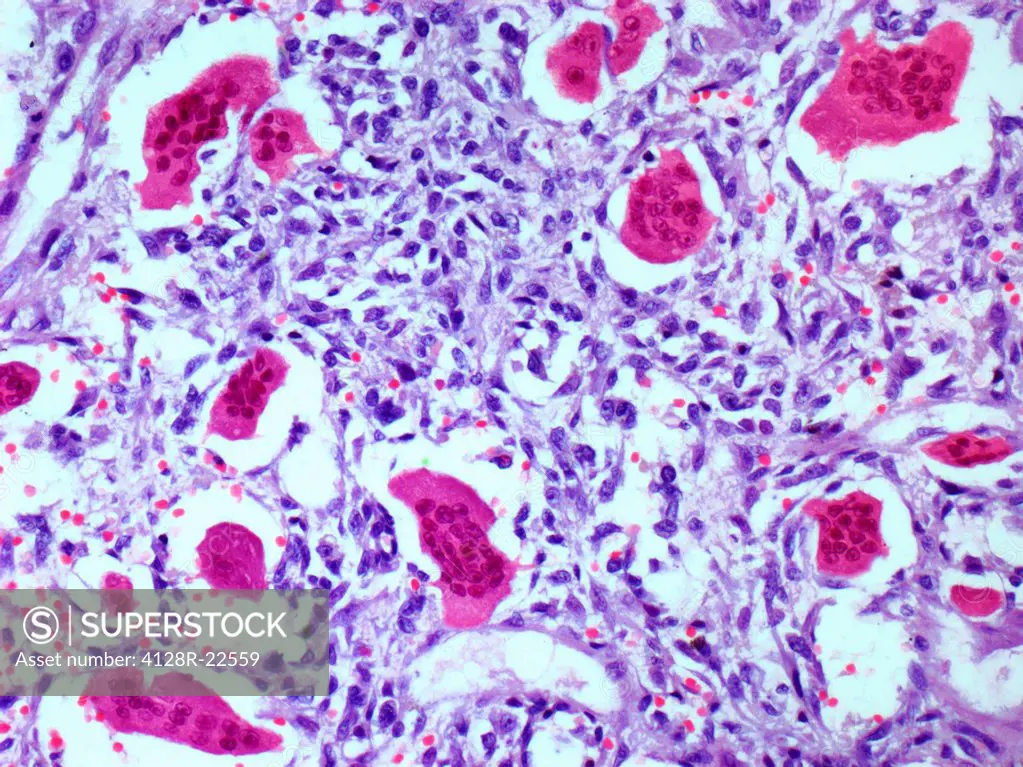 Bone tumour. Light micrograph of a section through a giant cell tumour of the bone. This tumour is characterized by the presence of multinucleated gia...