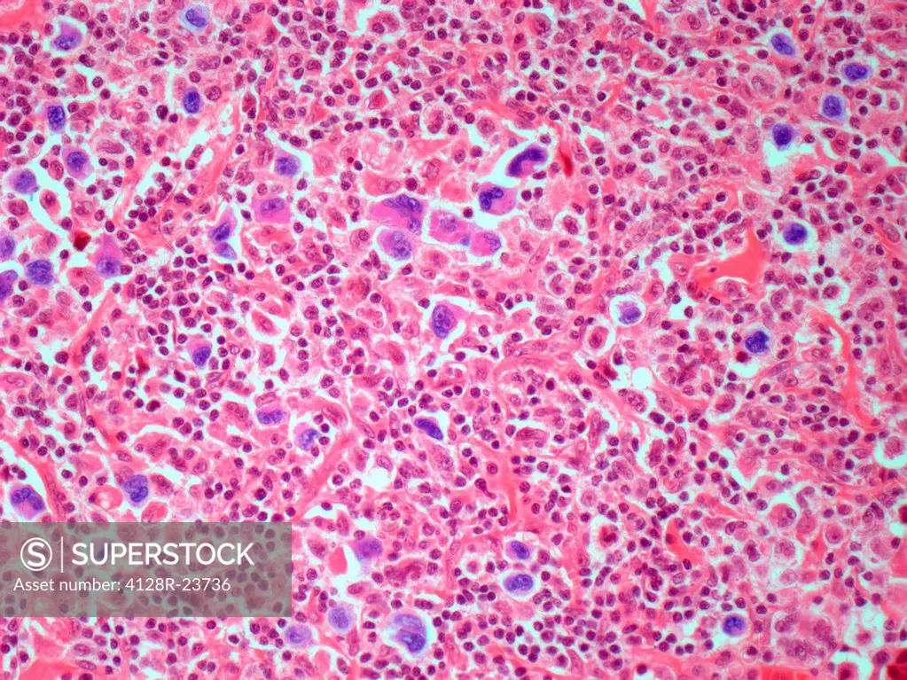 Hodgkin´s lymphoma. Light micrograph of a section through a lymph node affected by Hodgkin´s lymphoma. Several Reed_Sternberg cells are present, these...