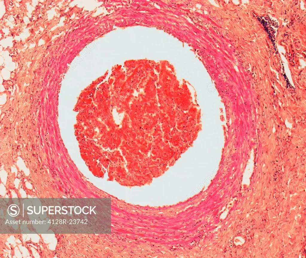 Blood clot. Light micrograph of a section through an arterial thrombus. Blood clots can form in an intact vessel that contains fatty deposits or one t...