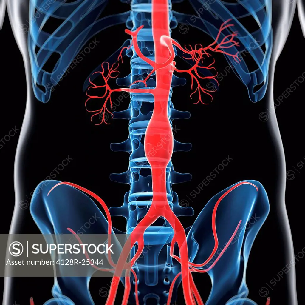 Aortic aneurysm. Computer artwork of a fusiform aortic aneurysm.