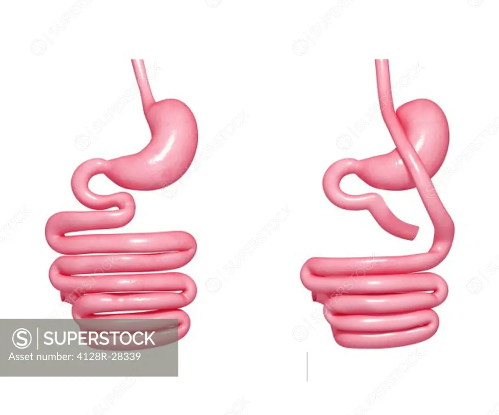 Gastric bypass. Computer artwork showing the digestive system, system, gastrointestinal, alimentary, gi, tract, gut, before (left) and after (right) a...