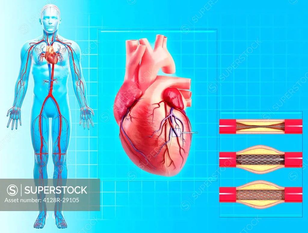 Balloon angioplasty. Computer artwork of a stent being placed in a narrowed blood vessel.