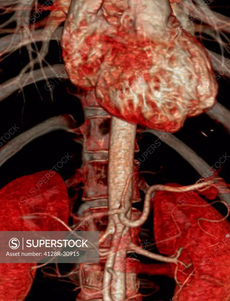 Abdominal aorta. Coloured 3D computed tomography (CT) angiogram of the abdominal aorta in a 42 year old patient. The aorta is the body's main artery. ...