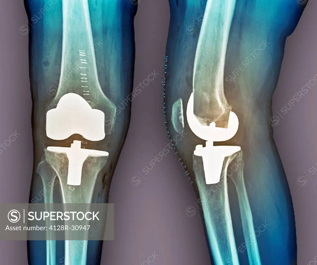 Total knee replacement. Coloured frontal (left) and profile (right) X-rays of the right knee of a 69 year old patient after total knee replacement sur...