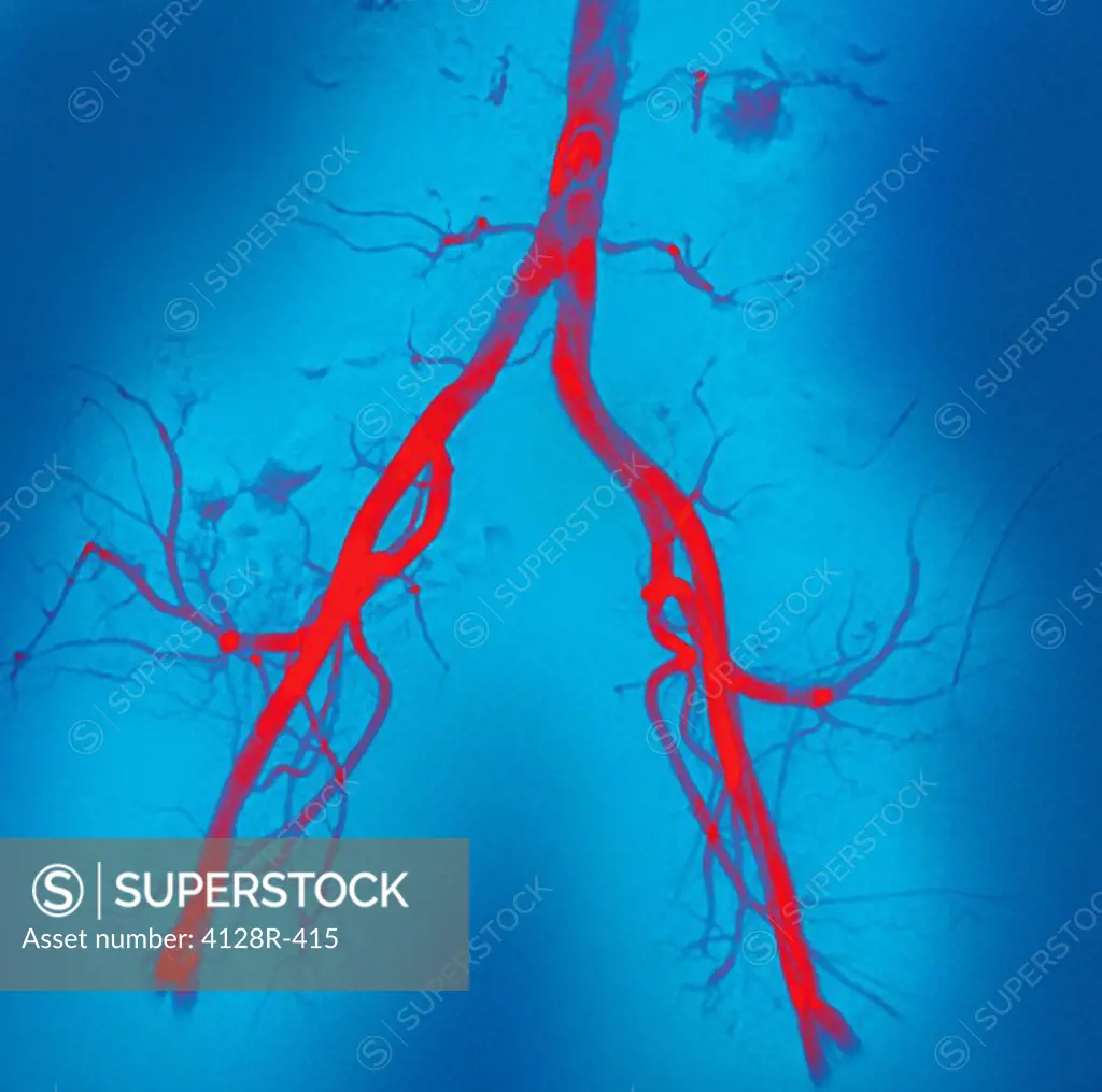 Normal abdominal arteries, angiogram