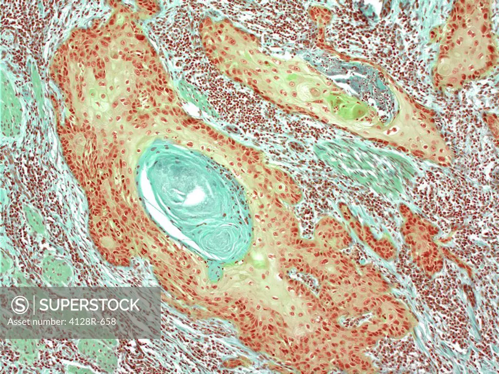 Skin cancer. Light micrograph of a section through a squamous carcinoma of the skin. Whorls of enclosed keratin green, centre left are a common featur...