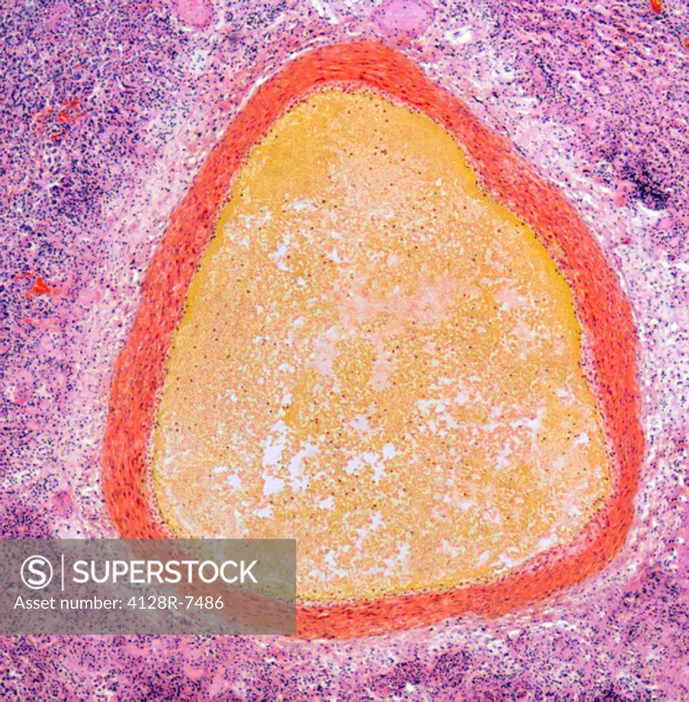 Lung aneurysm, light micrograph. The lumen of the blood vessel is occluded with a large thrombus orange. The vessel endothelium and muscle is largely ...