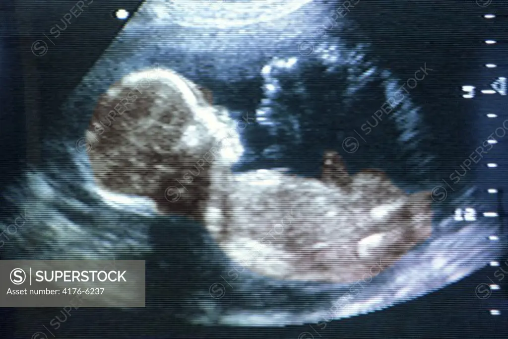 5 to 7 month old fetus seen during ultrasound test