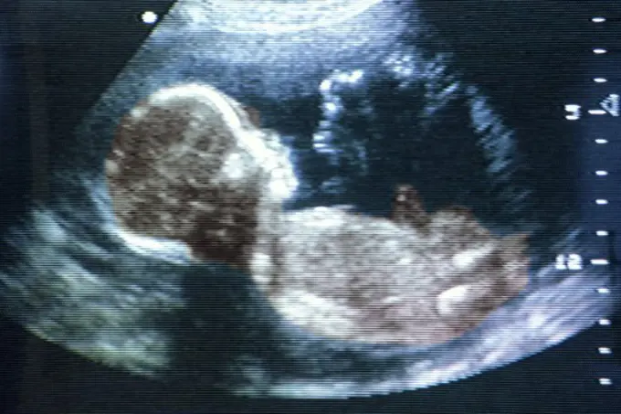 5 to 7 month old fetus seen during ultrasound test