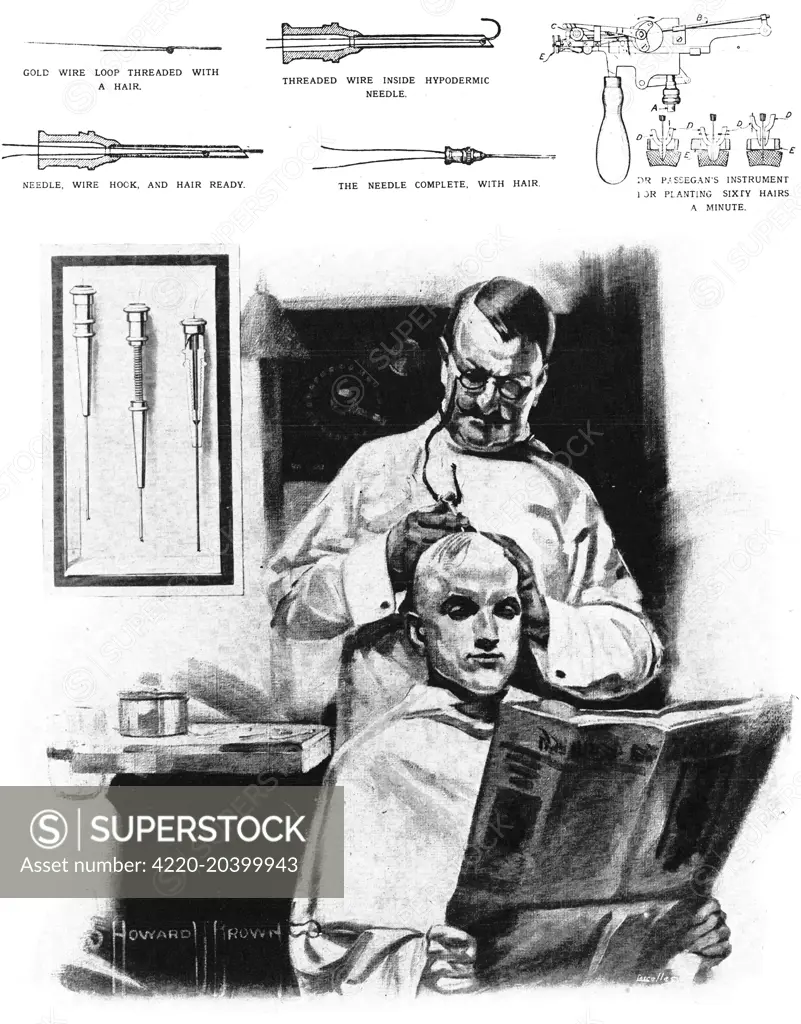 Entitled, 'If the War Makes you Lose Your Wool - Try This', this illustration shows an early form of hair transplanting, championed by a Dr. Szekely of Budapest.  The technique, which threaded a wire with hair, which was then injected into the scalp through a hypodermic needle, could apparently plant as many as sixty hairs a minute in the patient's head, without, according to the picture, discomfort.     Date: 1914