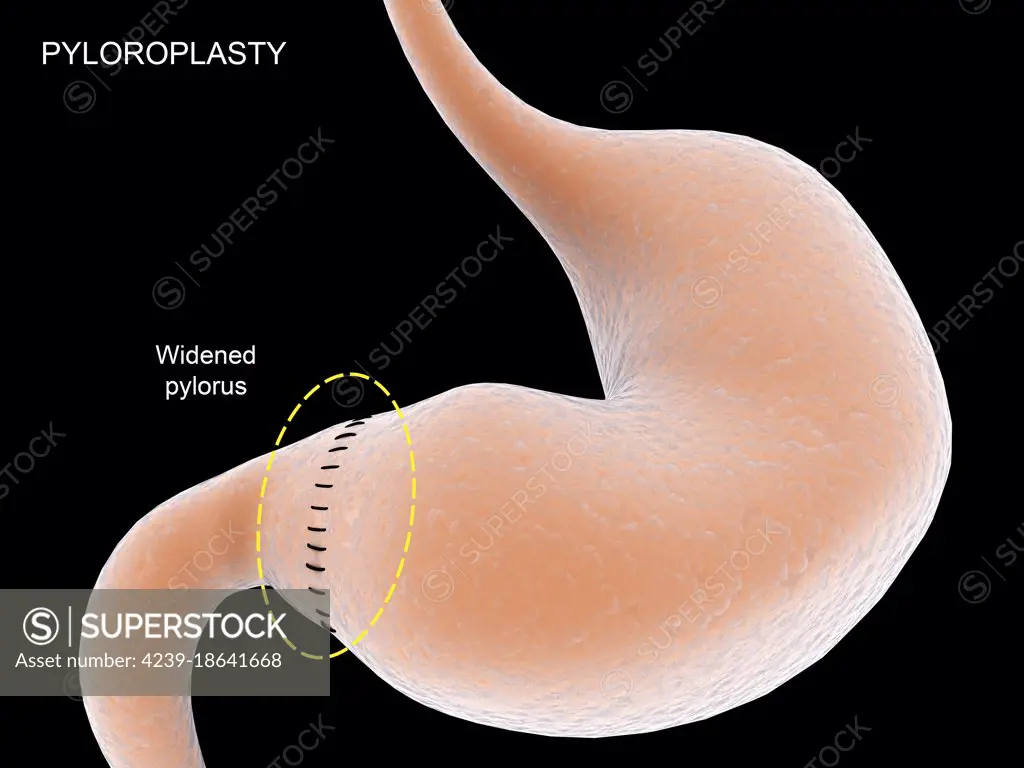 Medical illustration showing pyloroplasty, which widens the pylorus in stomach.