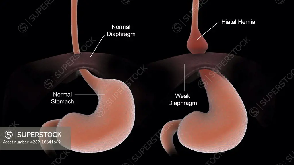 Medical comparison of a healthy human stomach, and an unhealthy human stomach with hiatal hernia.