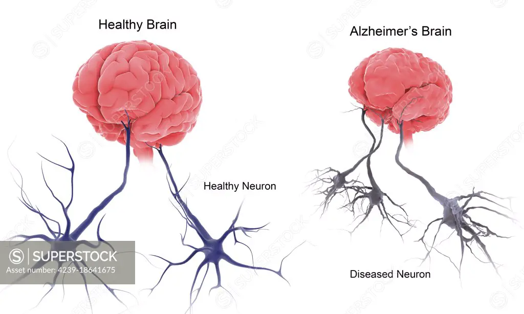 Medical comparison of a healthy brain and a brain with alzheimer's.