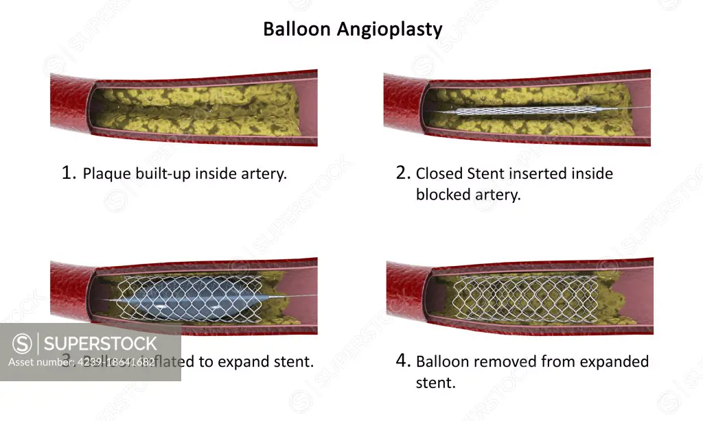 Diagram showing procedure of balloon angioplasty to widen obstructed arteries.