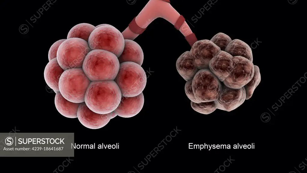 Medical comparison of healthy alveoli and an unhealthy emphysema alveoli.