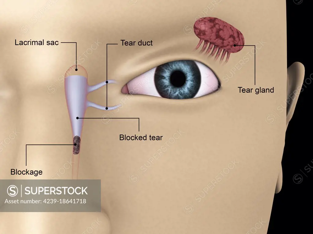 Diagram illustrating blocked tear ducts in the human eye.