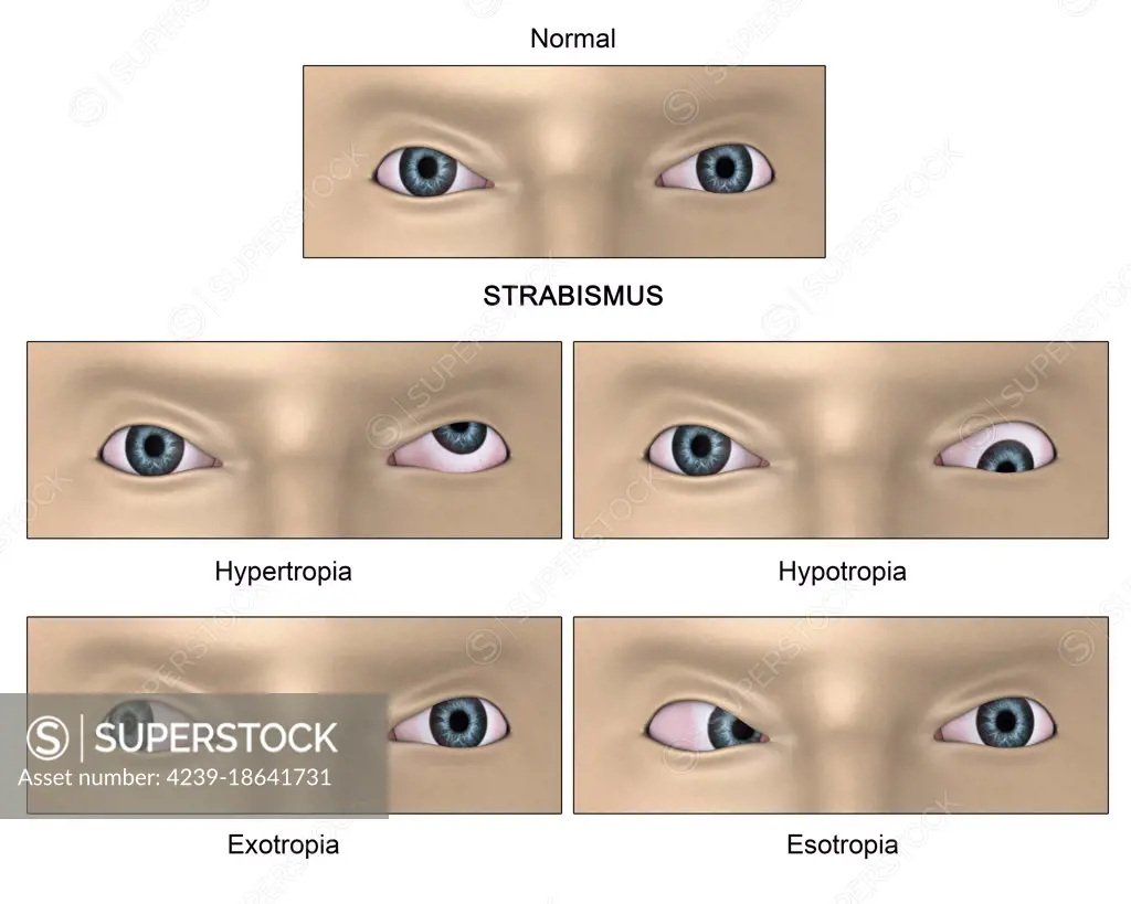 Strabismus: A condition of being wall-eyed or cross-eyed