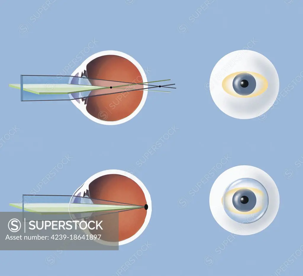 Astigmatism and correction with corrective lens.