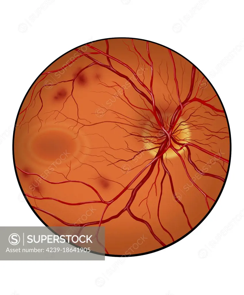 Retina with neovascularization showing retinal hemorrhaging.