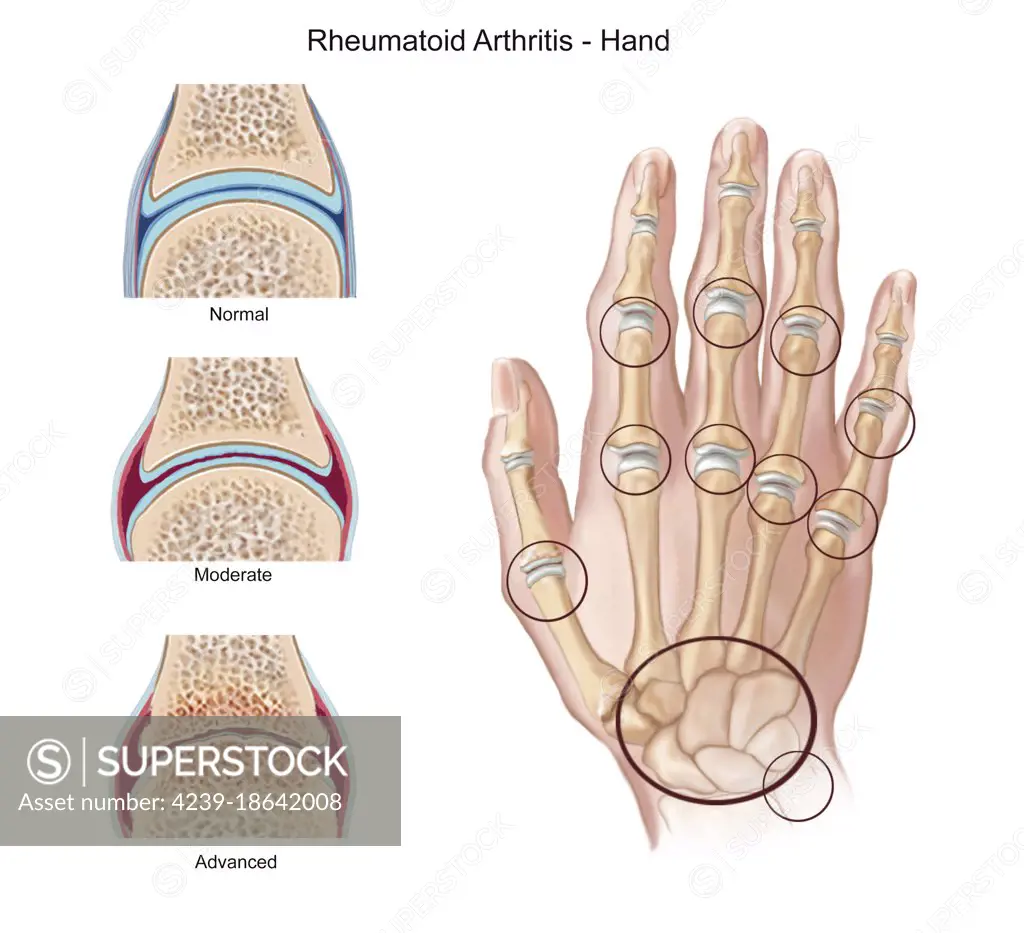 Stages of rheumatoid arthritis on hand, with highlight of joints involved.