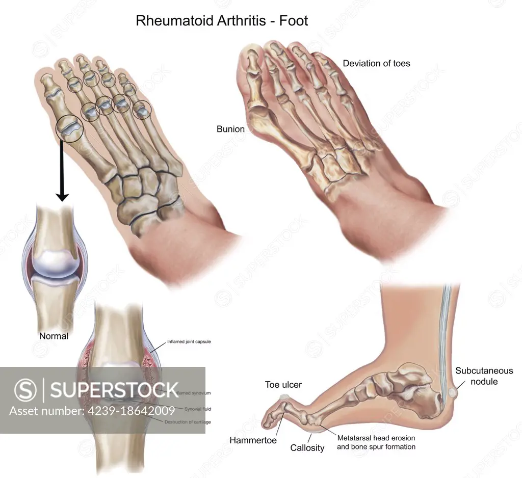 Top and side view of foot showing deformities caused by rheumatoid arthritis.