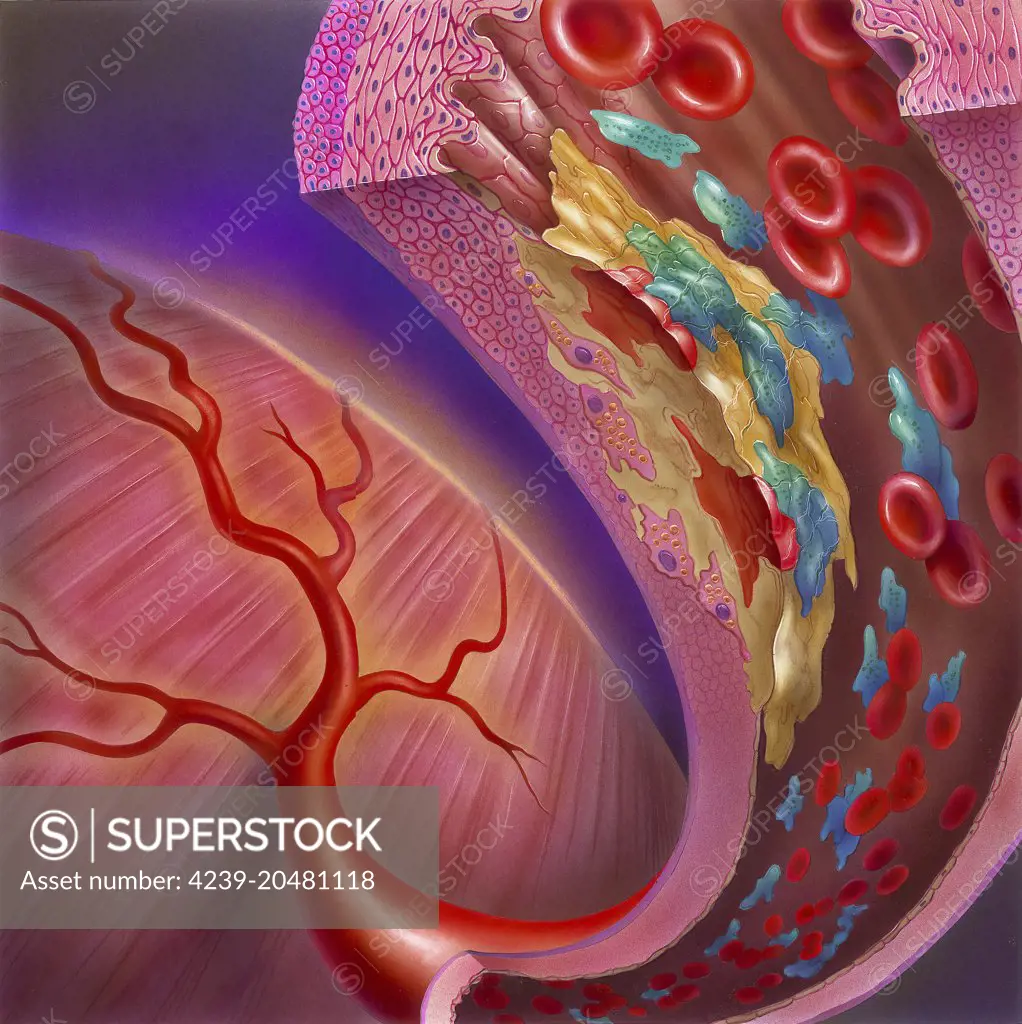 Close-up of artery showing atherosclerotic plaque, platelets and red blood cells.