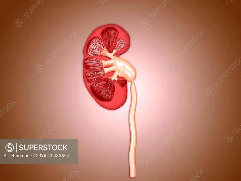 Ureteropelvic junction (UPJ) obstruction in the kidney. UPJ is defined as an obstruction of the flow of urine from the renal pelvis to the proximal ureter.