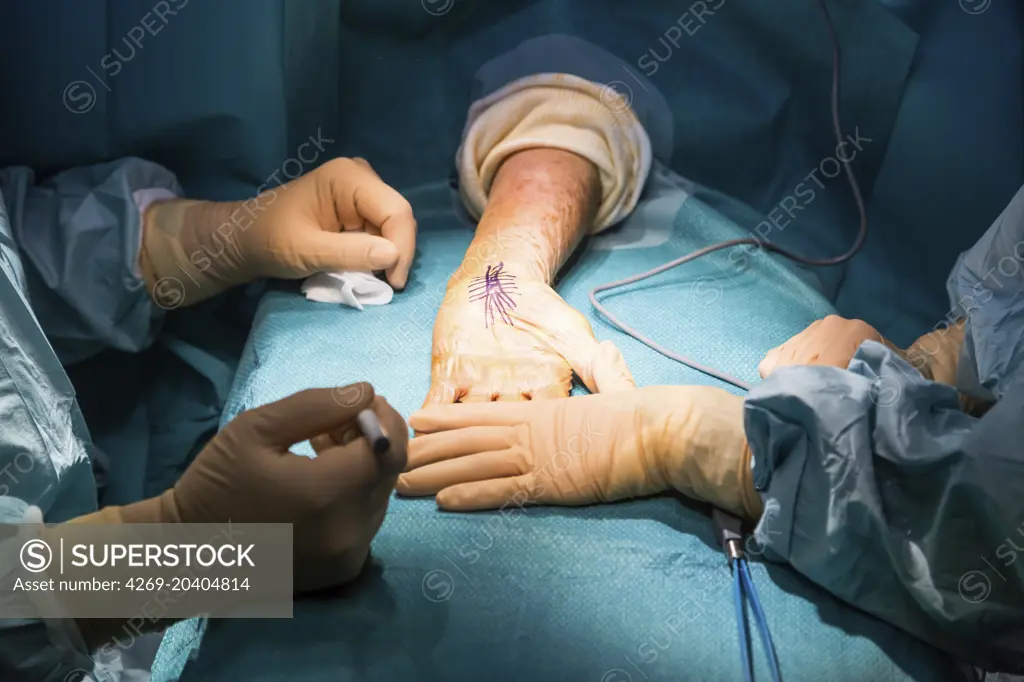 Carpal tunnel syndrome surgery.