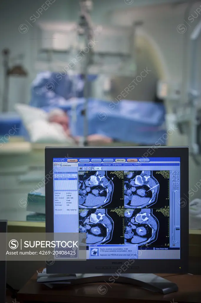 CT scan-assisted cryotherapy to destroy a kidney tumor, Saint-Louis hospital, Paris, France.