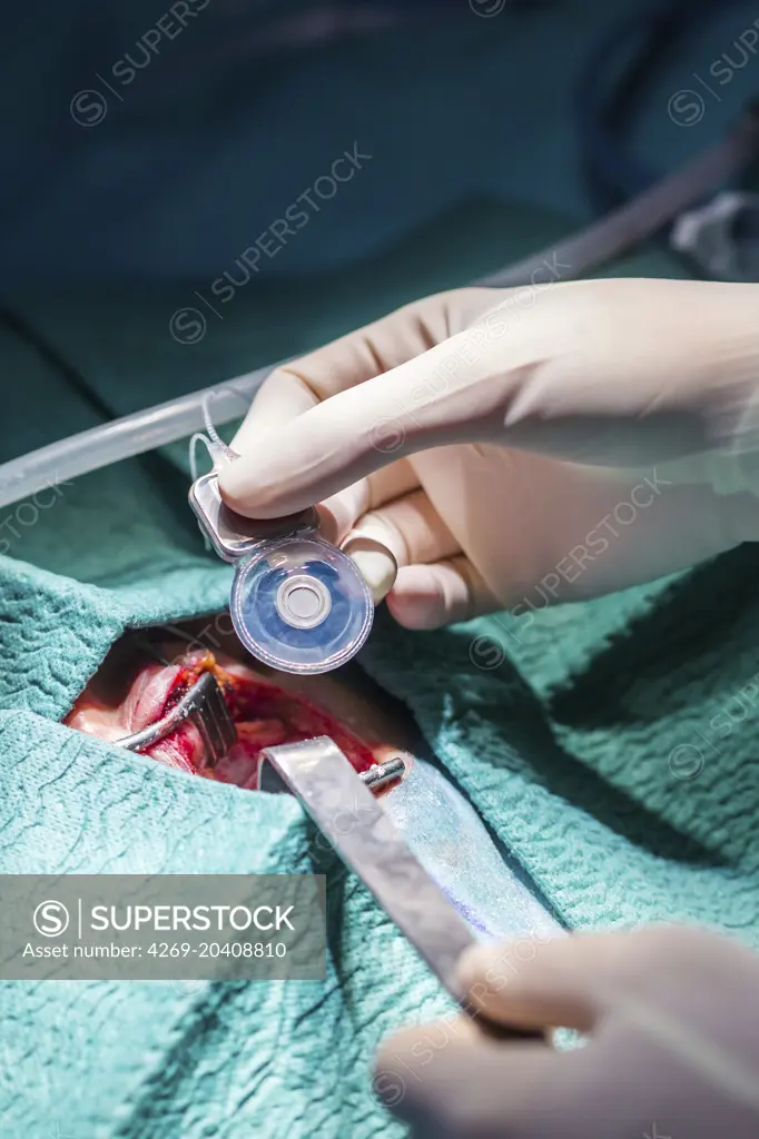 Surgeon performing cochlear implant surgery, an operation involving the implantation of a small electronic device used to provide a sense of sound to a deaf person, Limoges hospital, France.