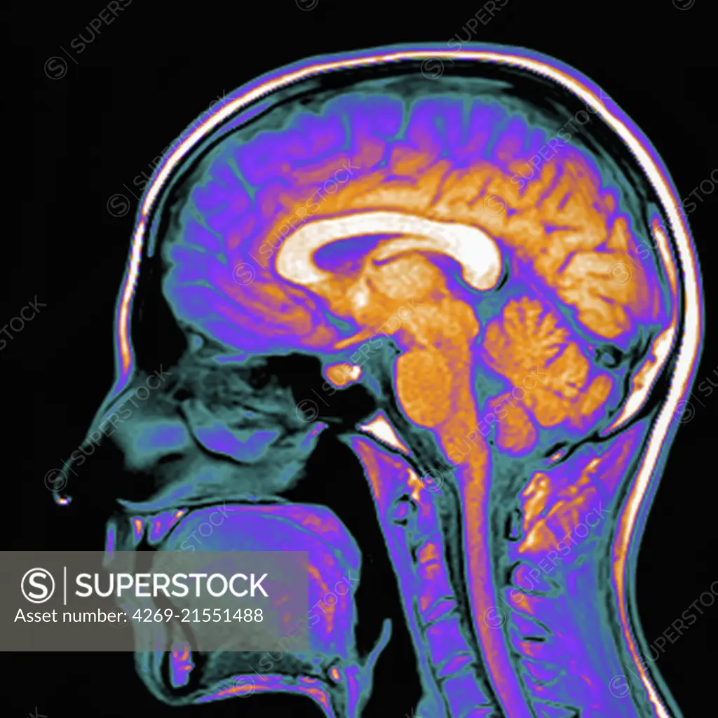 Coloured magnetic resonance imaging (MRI) scan of a sagittal section through a patient's head showing a healthy human brain.