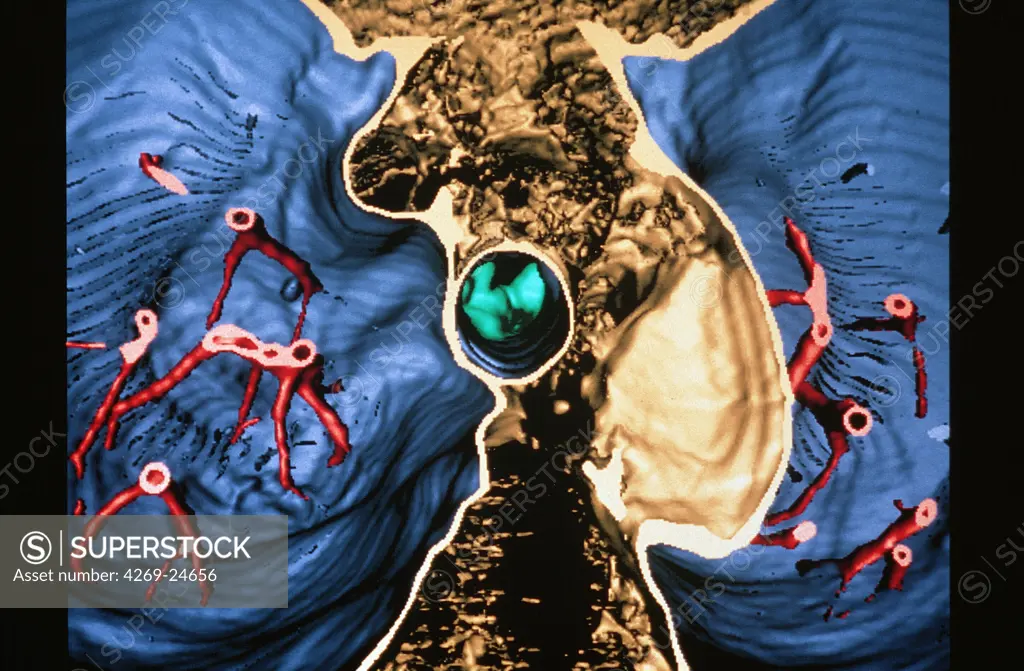 Lesion of the trachea. 3D computed tomographic (CT) scan reconstruction (virtual endoscopy) showing a lesion on the trachea viewed from under.