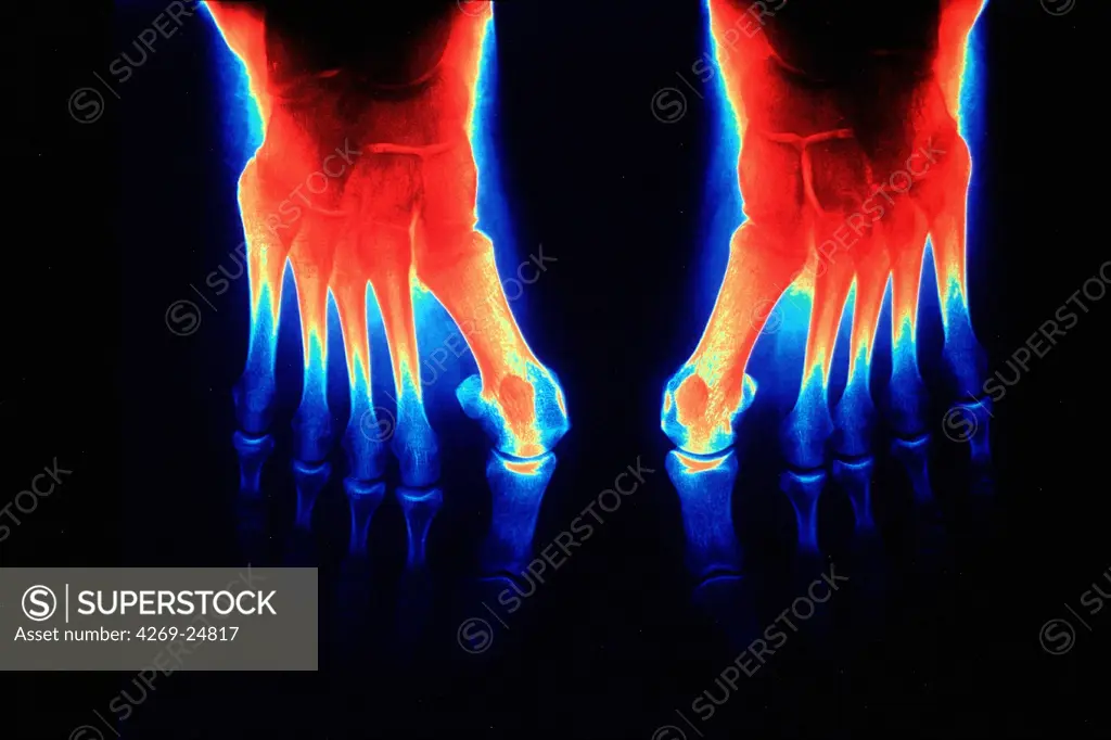 Hallux valgus. Color enhanced x-ray of Hallux valgus described by the outward displacement of the big toe, associated with a bunion (swelling of joint between great toe and first metatarsal bone).