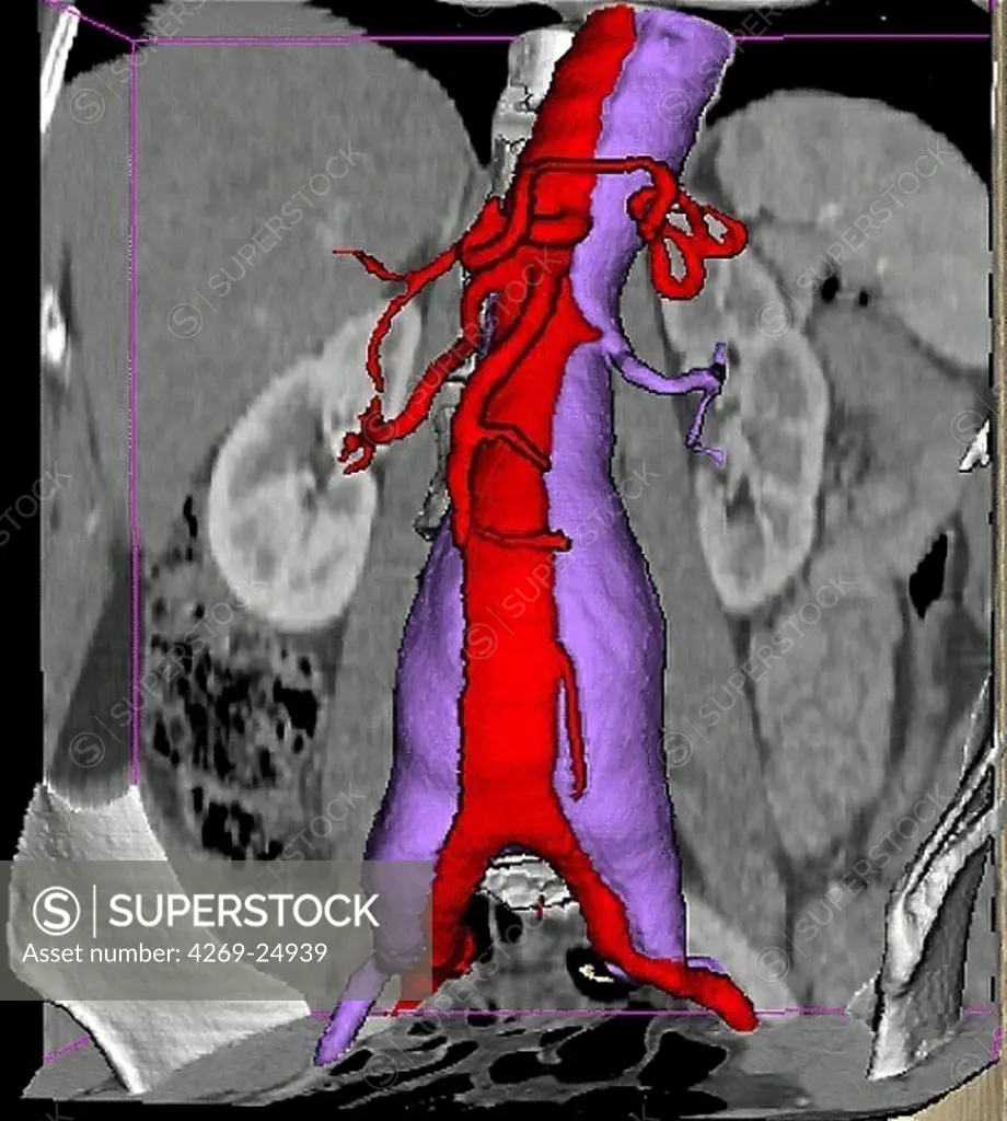 Dissecting aneurysm of the aorta. 3D computed tomographic (CT) scan reconstruction of a dissecting aneurysm of the aorta.