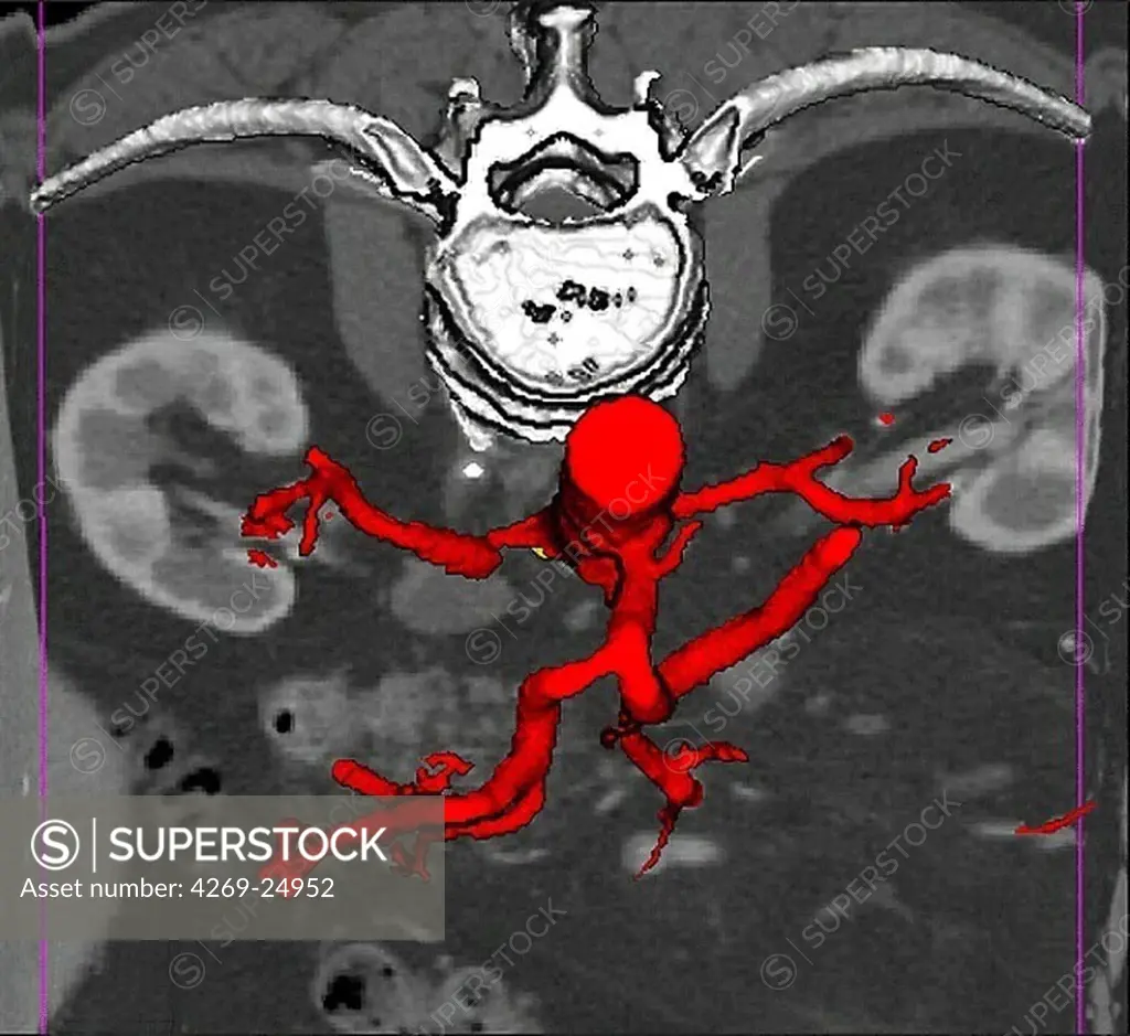 Stenosis. 3D computed tomographic (CT) scan reconstruction of the right renal artery stenosis, responsible for arterial hypertension and renal ischemia.