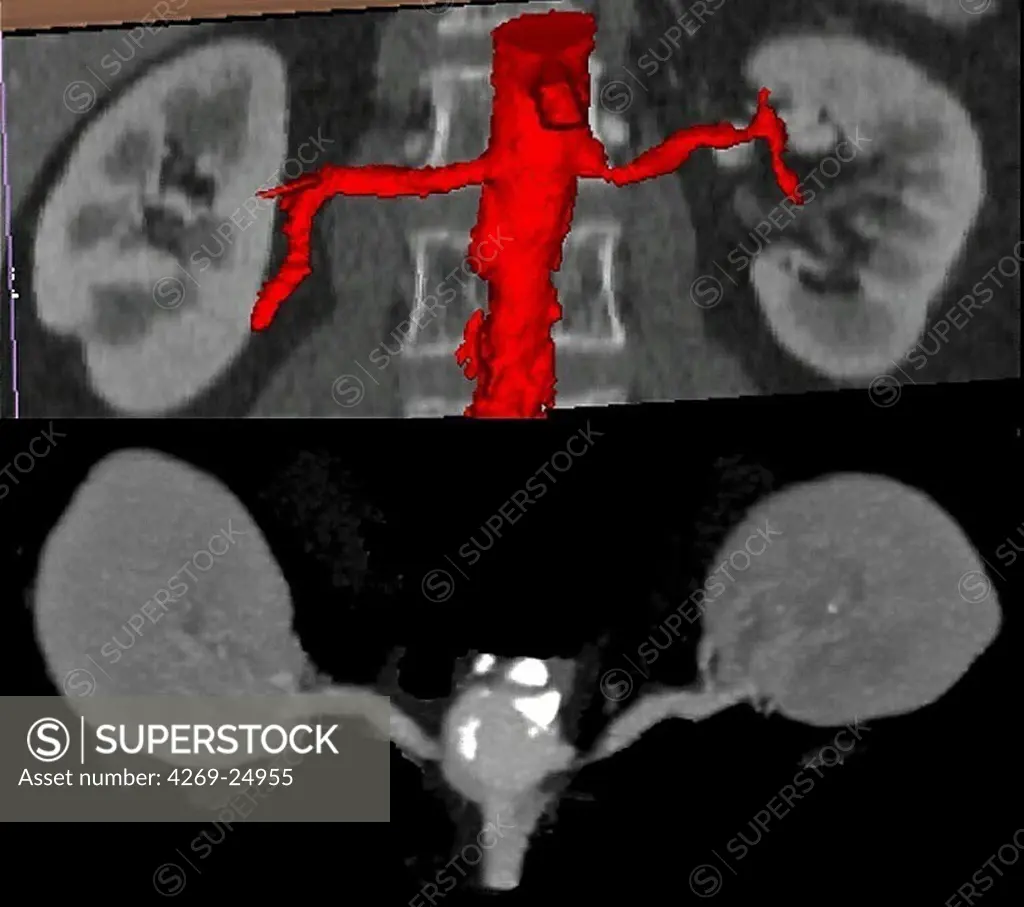 Stenosis. 3D computed tomographic (CT) scan reconstruction of the left renal artery stenosis, responsible for arterial hypertension and renal ischemia.