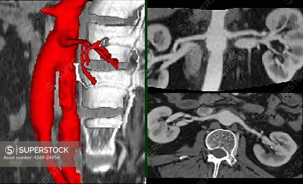 Stenosis. 3D computed tomographic (CT) scan reconstruction of the left renal artery stenosis, responsible for arterial hypertension and renal ischemia.