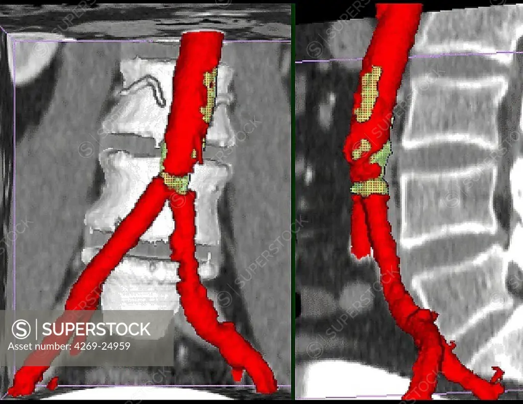 Stenosis of the aorta. 3D computed tomographic (CT) scan reconstruction of an atheromatous stenosis of of the aorta, visible just before its division in 2 iliac arteries. The atheroma plaques causing the stenosis are seen in yellow.