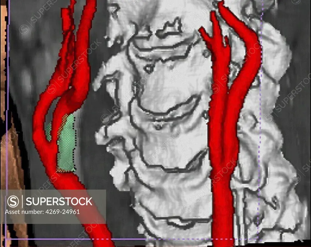 Stenosis of carotid artery. 3D computed tomographic (CT) scan reconstruction of an atheromatous stenosis of the right internal carotid artery.