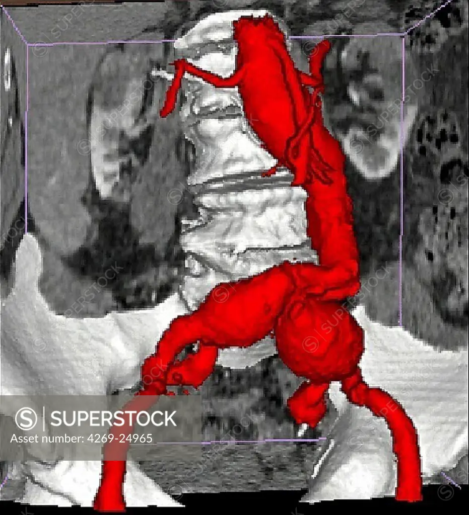 Bi-iliac aneurysm. 3D computed tomographic (CT) scan reconstruction of a bi-iliac aneurysm. The aneurysms appear as a swollen bulge located on  the beginning of the common iliac arteries that irrigate the lower limbs. An aneurysm is a bulge of a vessel due to the dilatation of its wall. A ruptured aneurysm can be fatal.