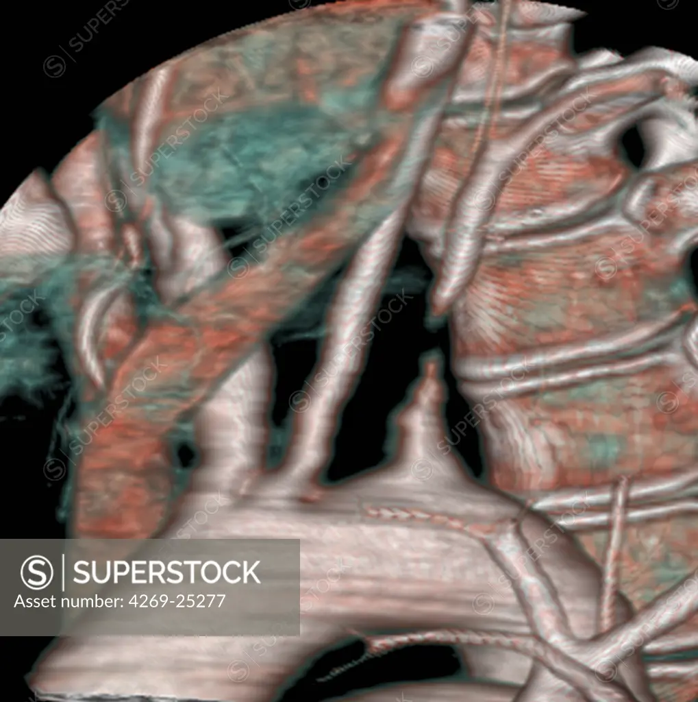 Subclavian artery stenosis. 3D computed tomographic (CT) scan reconstruction of the aortic arch, from which leave the associated arteries. At right, the left subclavian artery shows stenosis (narrowing).